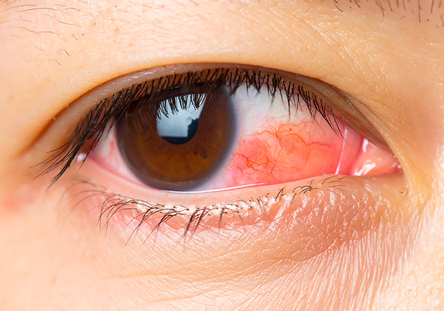 結膜の疾患